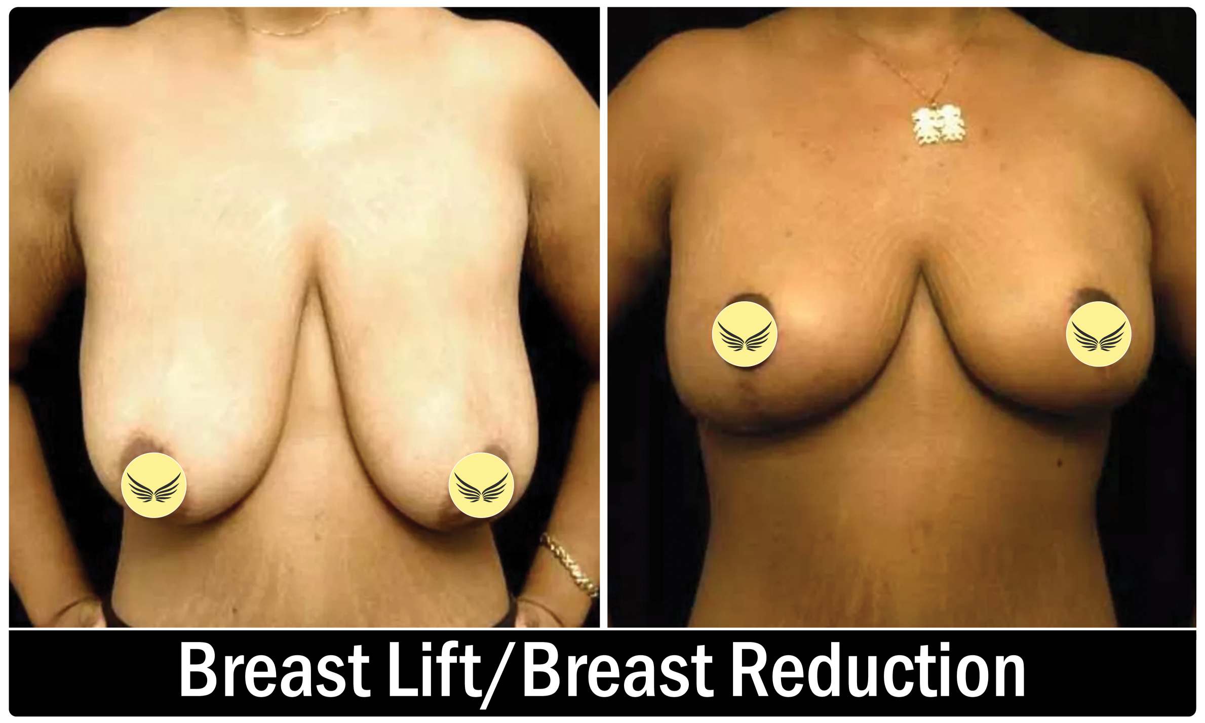 Breast Implant KOQ10